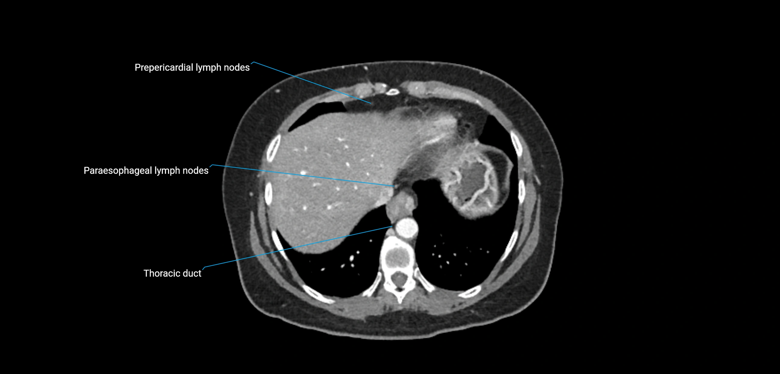 CT ct abdominal lymph nodes  axial cross sectional anatomy  enchanced radiology image -img-00002-00073.webp